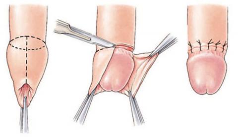 Penis before and after circumcision - Mayo Clinic