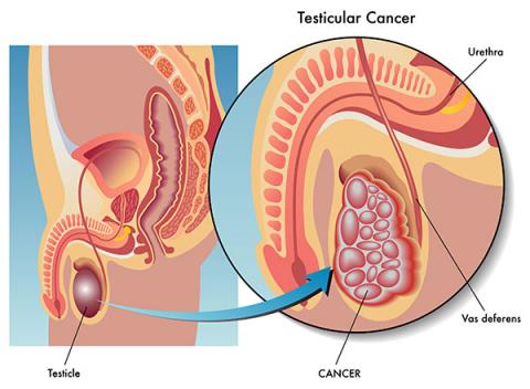 Testicular cancer test